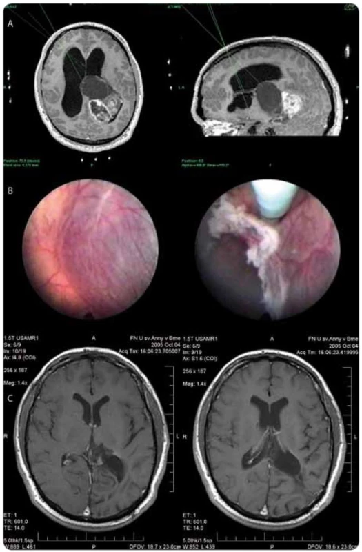 Muž, 20 let, klinicky nitrolební hypertenze, v prvním stadiu endoskopická septostomie, fenestrace cysty, histologická verifikace (pleomorfní xanthoastrocytom II ). a) plánování trajektorií pro neuroendoskopické operace, b) endoskopický obraz před fenestrací pseudocysty a po její fenestraci, c) MRI obraz po provedené resekci.