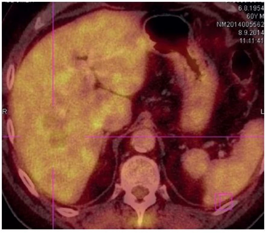 PET/CT vyšetření po neoadjuvantní chemobioterapii
Fig. 1: PET/CT scan after neoadjuvant chemo-biotherapy
