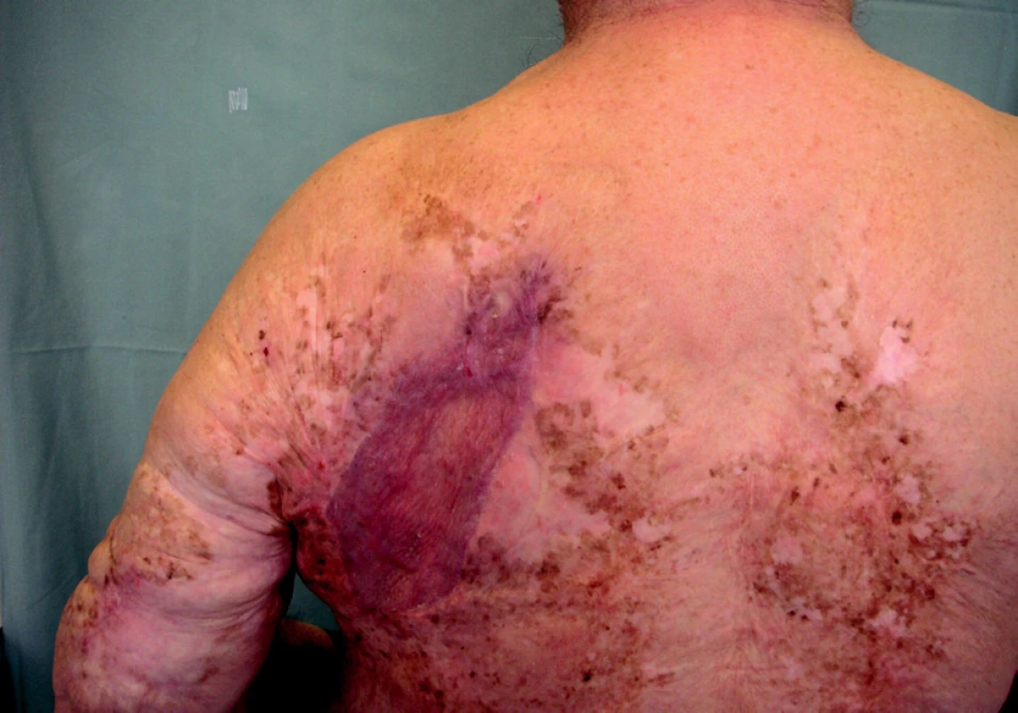 Stav po excizi a autotransplantaci kůže. Zhojeno primárně. 3/2005.