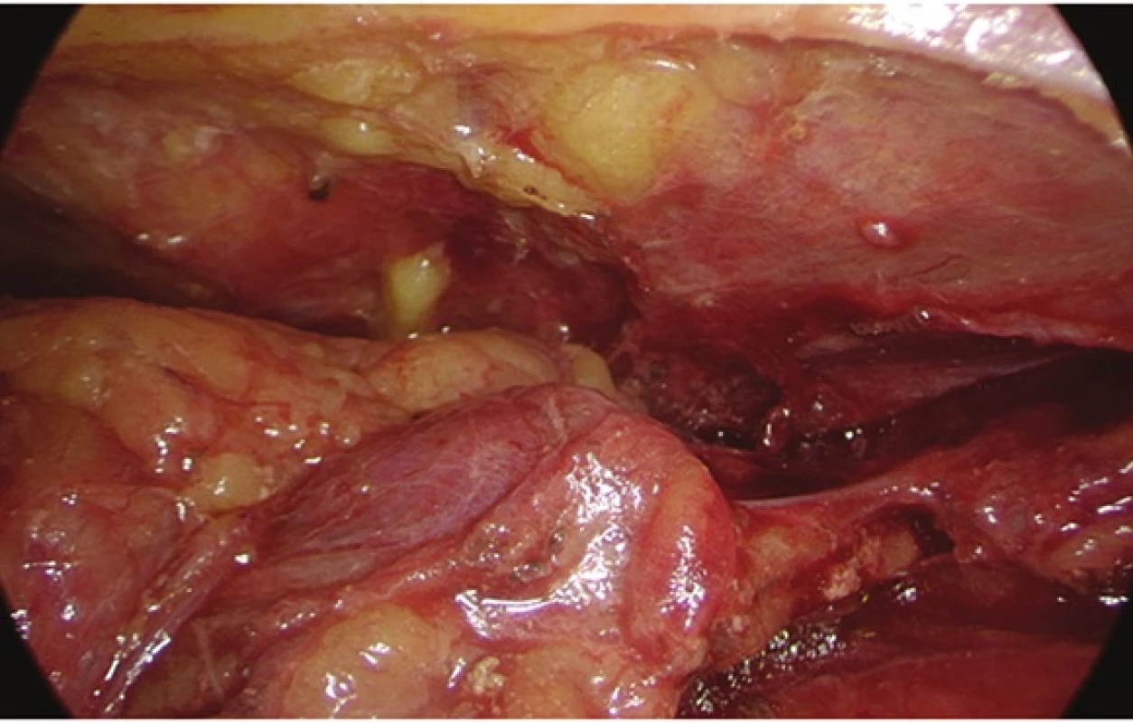 Videothorakoskopický pohled na adenom příštítného tělíska uloženého v thymu
Fig. 4: Videothoracoscopic view of parathyroid adenoma in the thymus