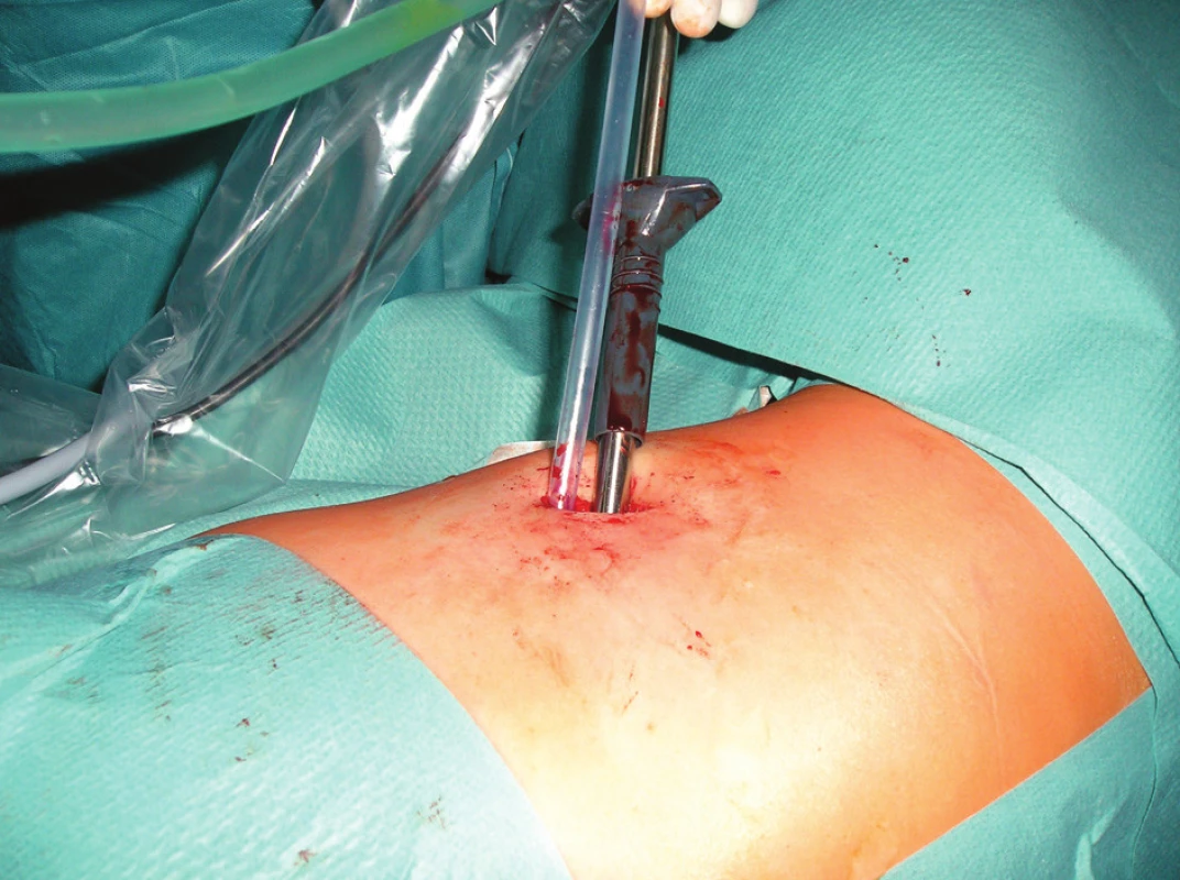 SITS – 10 mm optika a odsávačka pro otevřenou chirurgii
Fig. 2: SITS – 10 mm optics and suction unit for open surgical procedures
