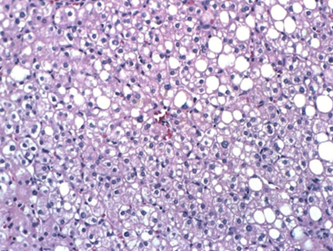Jaterní tkáň ze segmentu 4b s centrální vénou a v okolí hepatocyty s velkokapénkovou i malokapénkovou steatózou, HEM, 20x, Olympus AH3-RFCA
Fig. 5: Histological specimen. Liver tissue from segment S4b; central vein and macro- and micro-vesicular steatosis of the surrounding hepatocytes, HEM, 20x, Olympus AH3-RFCA