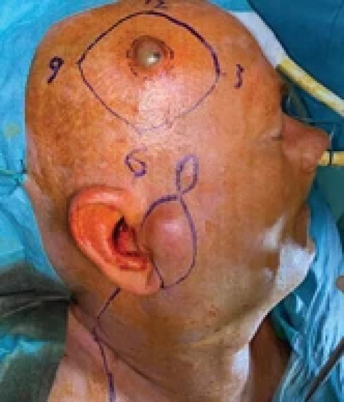 Preoperative photography - malignant melanoma of the scalp with metastases in the temporo- -parotid area.