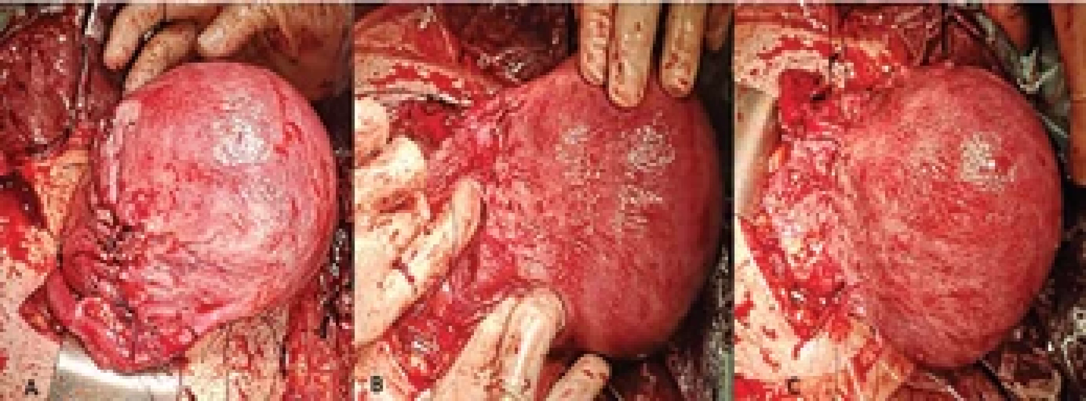 The lower uterine segment was incised along the posterior wall. Continuous entangled suturing of the posterior uterine wall, with left round ligament rotated anteriorly to the right (A). Further lysis of adhesions between bladder and lower uterine segment to allow correct rotation of the uterus. Note that the bladder is rotated posteriorly with respect to the anterior uterine wall (B). The uterus in physiological positioning following repositioning. Note the absence of the anterior uterine closure of the lower uterine segment (C).
