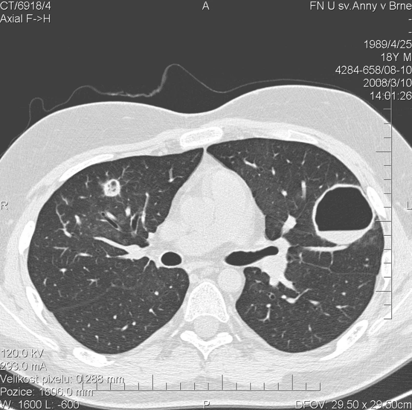 Multidetektorové CT 64 řady GE Lightspeed VCT: HRCT plic: Stacionární obraz denzit mléčného skla. Progrese počtu a velikosti kulovitých ložisek v plicním parenchymu. V levé plíci celkem 9 ložisek. V pravé plíci 5 větších a 3 drobná ložiska do 4 mm. U menších ložisek převažuje silnější lem a centrálně je jen menší vzdušná dutina.Větší ložiska jsou vyplněné vzduchem a jejich lem je tenký. Zde zachyceno největší ložisko v horním laloku ve ventrálním segmentu levé plíce o velikosti 42 mm s hladinkou tekutého obsahu.
