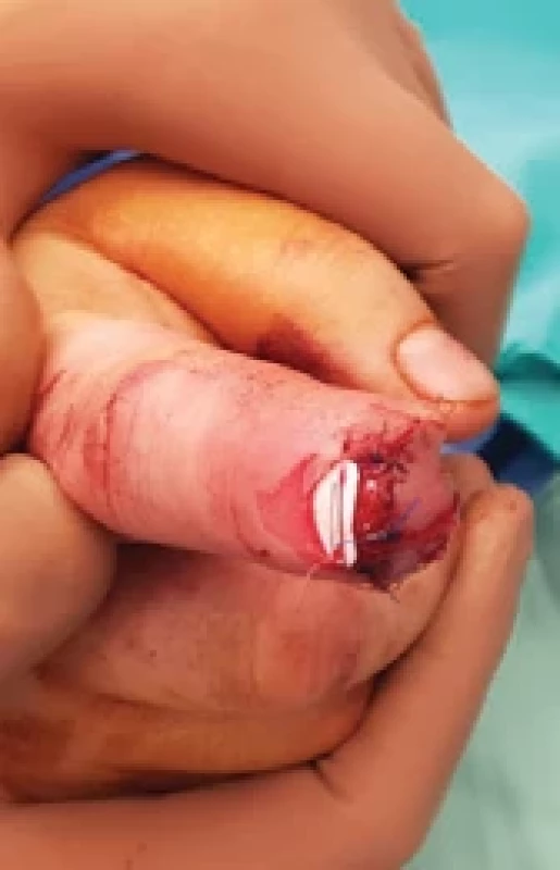 Transposed fl ap covering the bone and artifi cial nail replacement in its fi nal position.