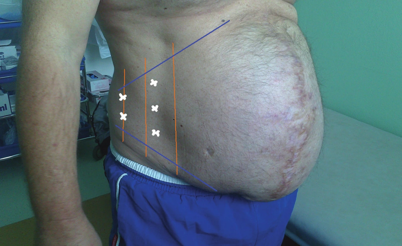 Pacient po aplikaci botulotoxinu a schéma aplikace
Fig. 2: Patient after botulotoxin chemical paralysis and the administration scheme