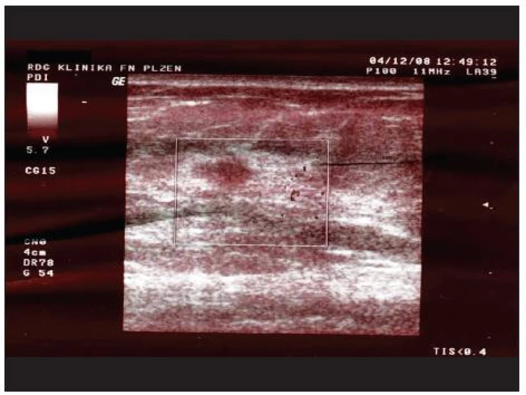 Sonografie pravého prsu – podezřelé ložisko v HZK
Fig. 3. Sonography of the right breast – suspicious focus in the upper outer quadrant