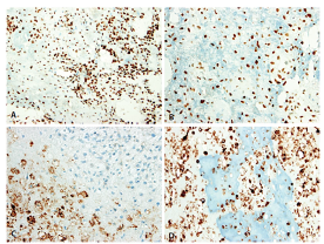 Imunohistochemický průkaz antigenů SATB2 a D-2-40 dovolil spolehlivě odlišit nejen histogenetickou orientaci původního mezenchymu, ale i pravou podstatu výrazně kalcifikované rozdílné extracelulární matrix. A, B: Exprese SATB2 v nádorovém stromatu resp. mineralizovaném osteoidu. C, D: Exprese D2-40 v konvenční resp. mineralizované chondroidní matrix; stroma je negativní (200x).