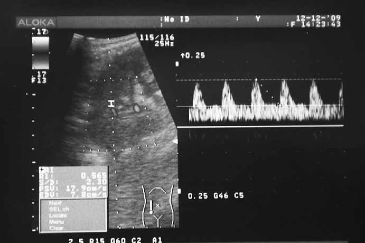 USG nález po obnovení prietoku krvi v transplantovanej obličke – stav po farmako-mechanickej trombektómii s lokálnou kontinuálnou trombolýzou rt-PA a implantáciou stentu do renálnej artérie transplantovanej obličky (rovnaký pacient ako obr. 1).