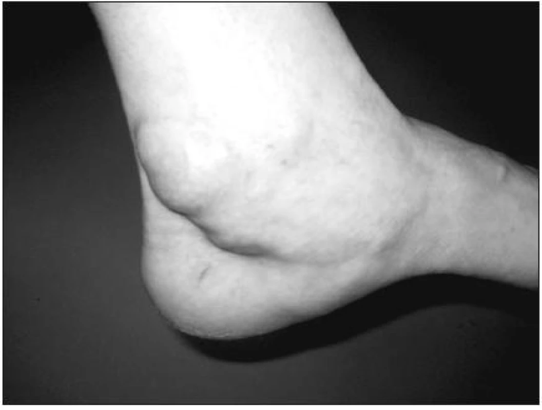 Synovialitida šlachy m. tibialis posterior.