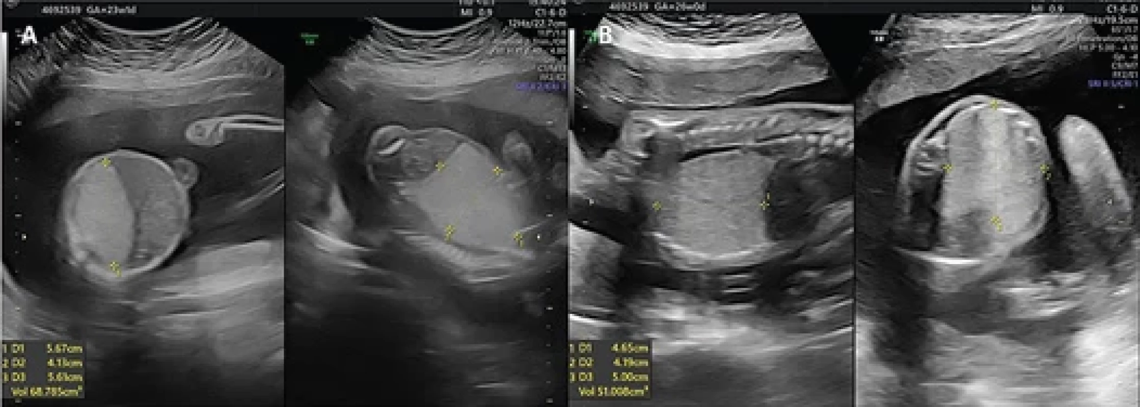 Obstetrical ultrasounds at 23 weeks and 1 day (A) and 26 weeks (B), respectively, at thorax level in axial and sagittal views showing the congenital cystic adenomatoid malformation volume calculation after corticosteroid therapy.