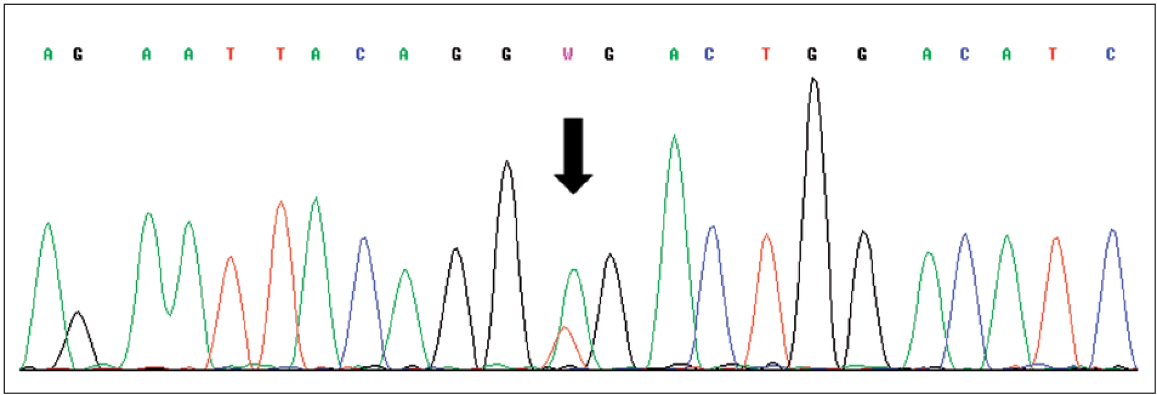 Sekvence části genu VHL, šipka označuje mutaci c.529A>T (p.R177X) v exonu 3
Fig. 3. Sequence of exon 3 of VHL gene with mutation c.529A>T (p.R177X) indicated by arrow