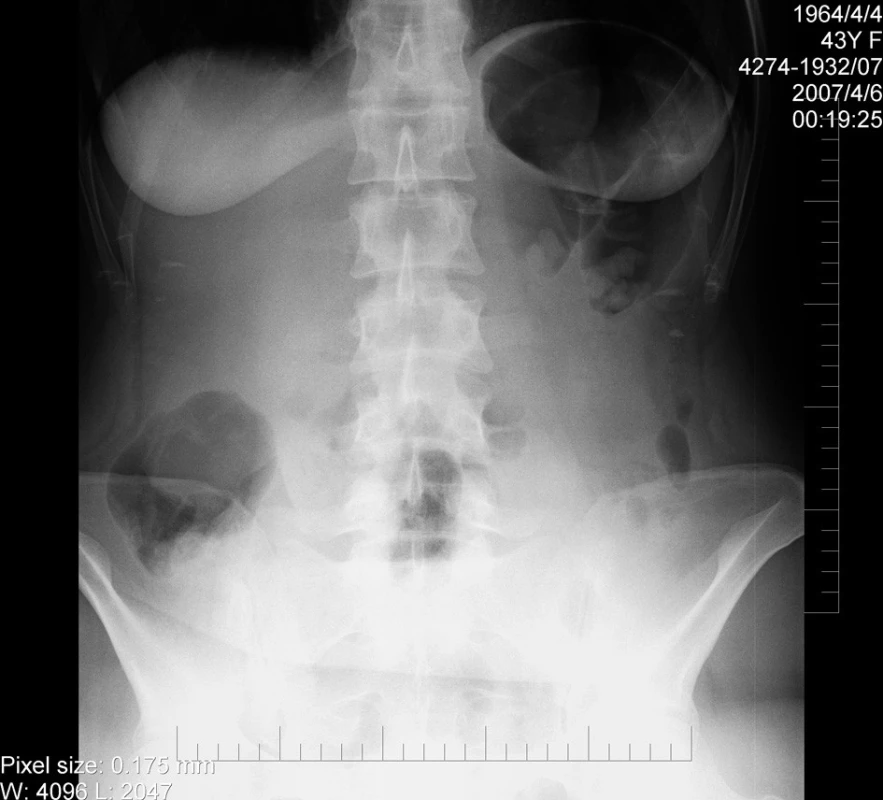 Prostý snímek pacientky při přijetí
Fig 1: Native X-ray taken during the patient’s admission