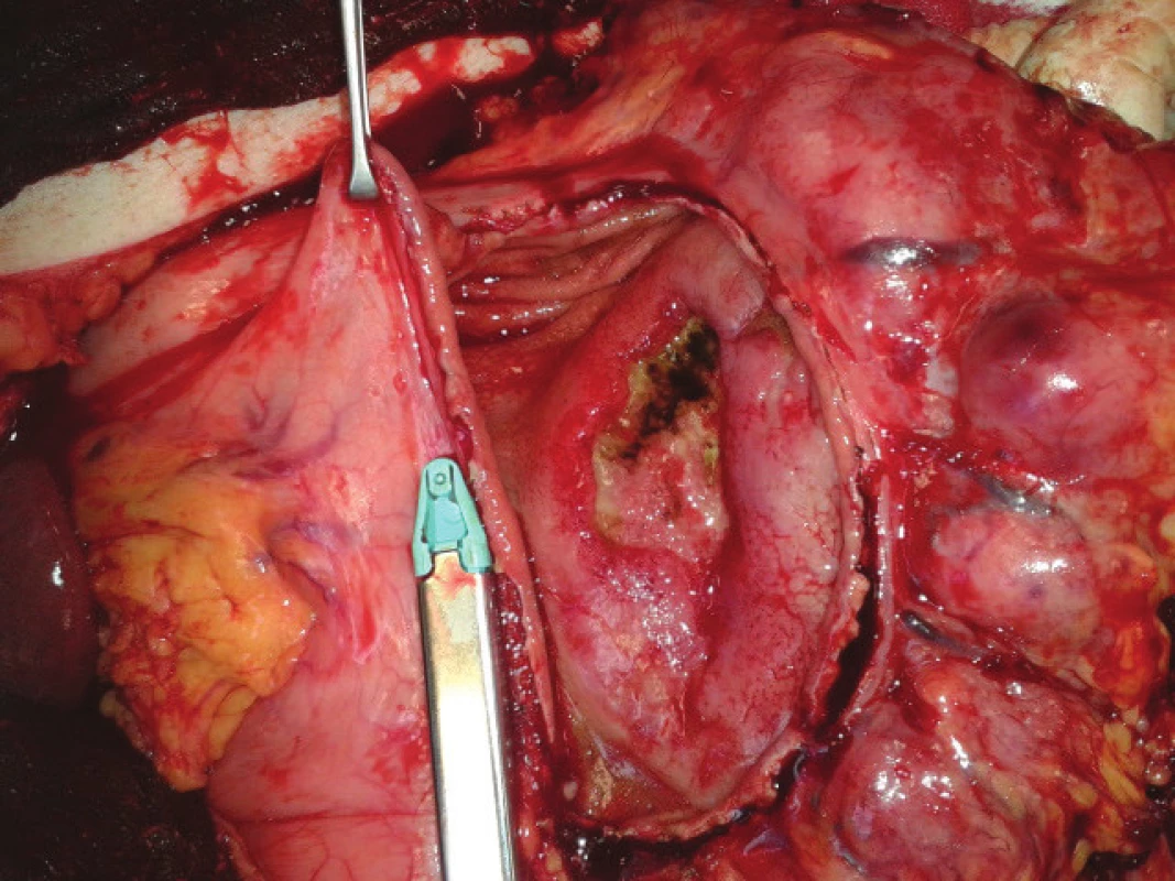 Staplerová sleeve resekce velké křiviny žaludku s objemnou vředovou lézí lymfomu intragastricky
Fig. 3: Linear stapler sleeve resection of the greater curvature with a large ulcerated gastric lymphoma
