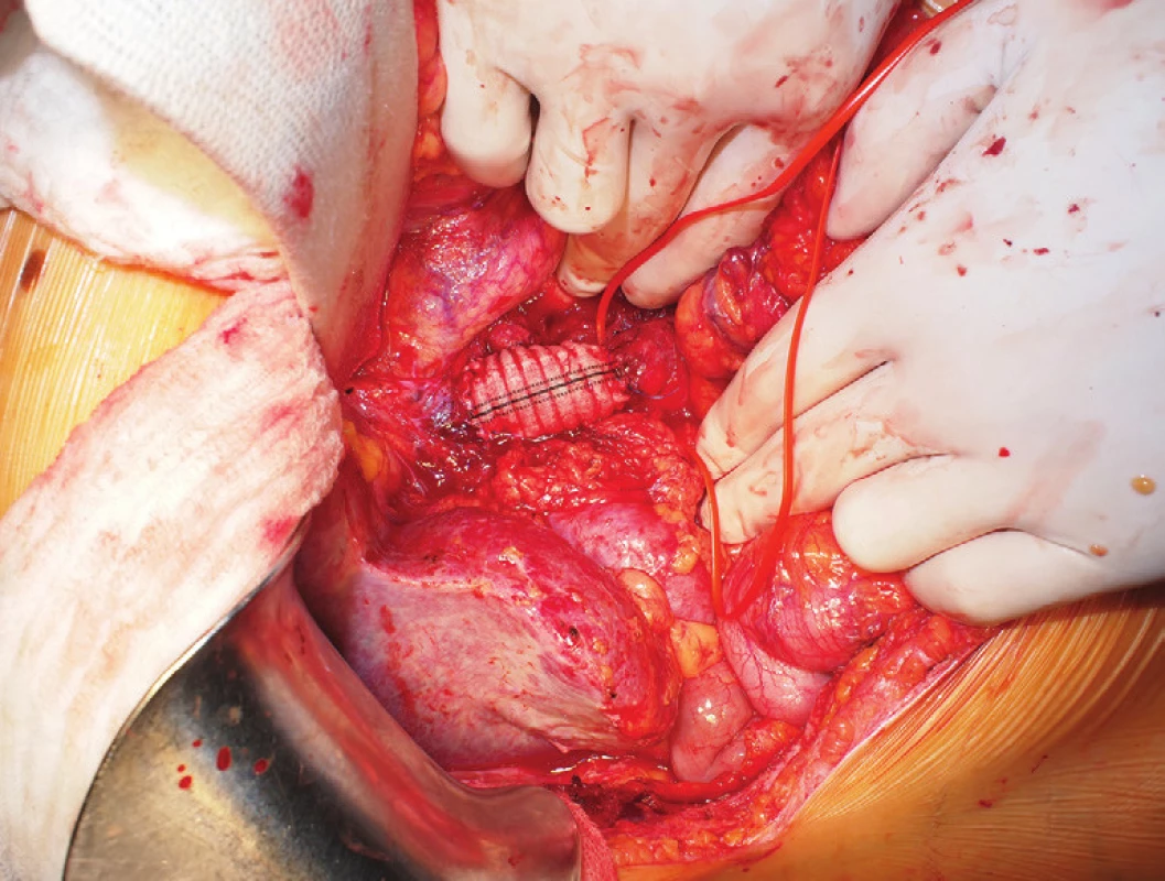 Stav po náhradě defektu ve v. cava inf. protézou
Fig. 7: The anterior wall of inferior caval vein substituted with a vascular prosthesis