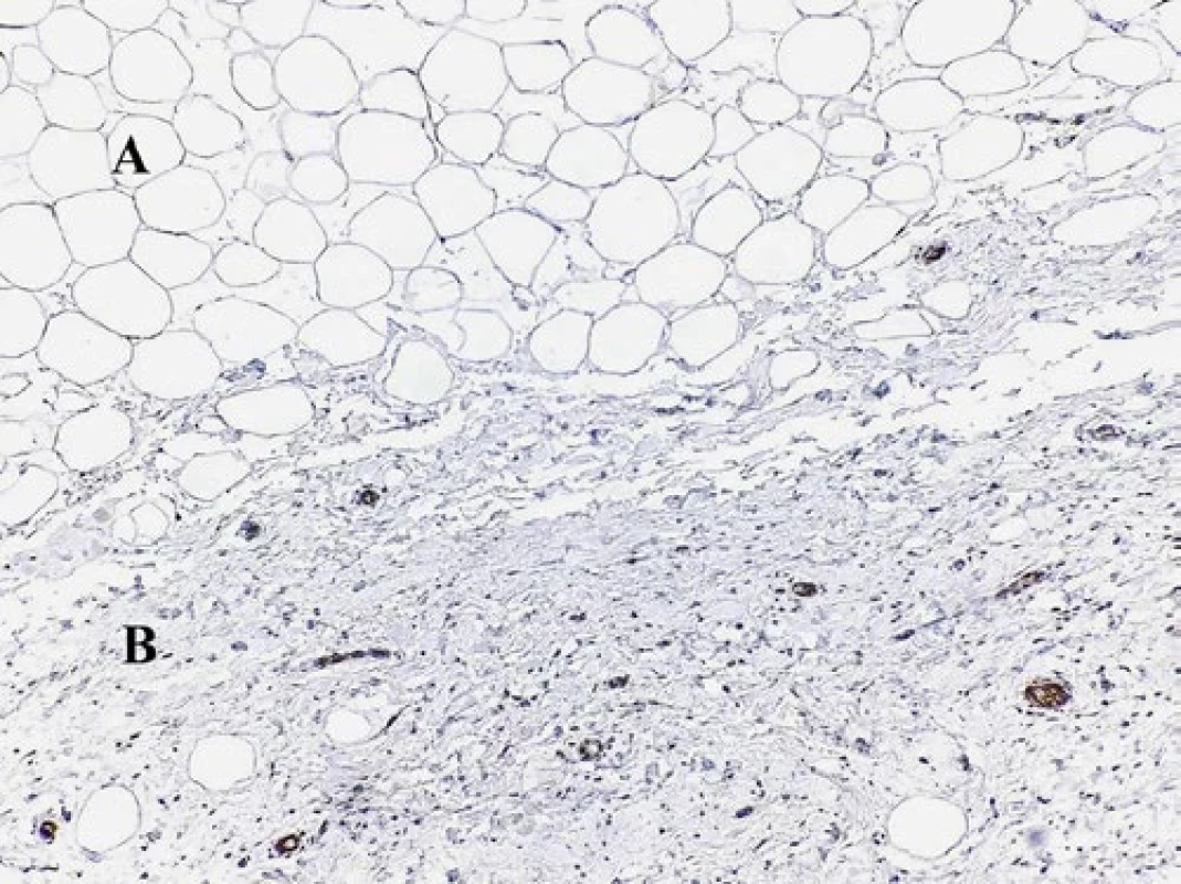 Imunohistochemický dôkaz MDM2. Vretenobunkový lipóm (B) je sčasti pozitívny, zatiaľ čo klasický lipóm (A) je negatívny. (objektív 20×)