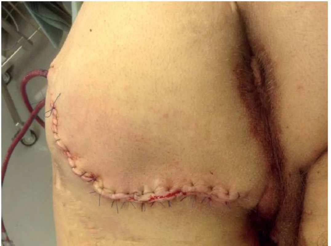 Výsledek operace: mobilizace kožního laloku, drenáž
Fig. 6: Result of the operation: mobilization of the skin flap; drainage