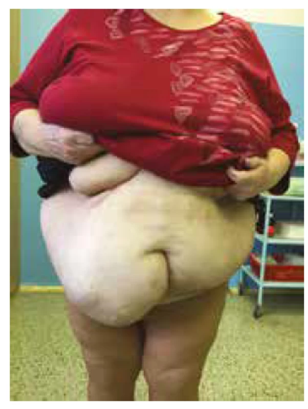 Pacientka s ventrální kýlou před plánovaným zákrokem<br>
Fig. 1: The pacient with ventral hernia before the surgery