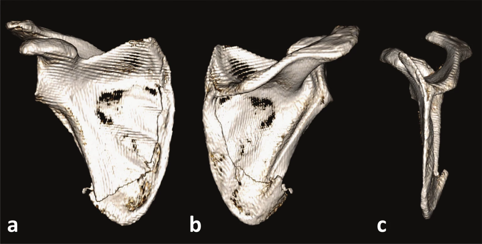 Zlomenina apexu dolního úhlu s postižením mediálního okraje
a – přední pohled, b – dorzální pohled, c – mediální pohled.
Fig. 5: Fracture of apex of the inferior angle with medial border involvement
a – anterior view, b – posterior view, c – medial view.