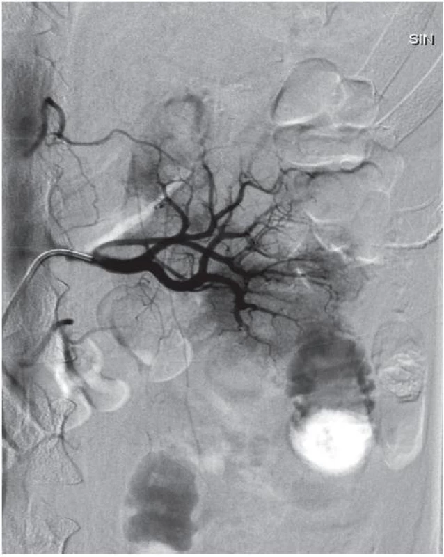 Kontrolní angiografie – průchozí renální arterie se zjevnou přetrvávající ischémií horní poloviny ledviny 
Fig. 3. Angiography 24 hours after the intervention – renal artery without thrombus, with apparent persistent ischaemia of the cranial kidney moiety