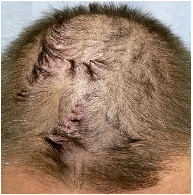 Folliculitis decalvans, erytém, krusty