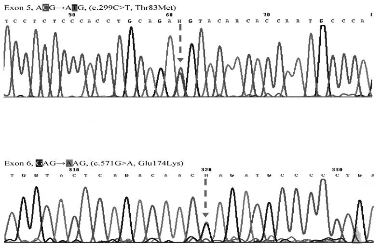 Sekvenčná analýza 5. a 6. exónu génu ALPL
Mutácie v heterozygotnom stave c.299C>T(T83M) a c.571G>A(E174K) sú označené na obrázku šípkou (u oboch sestier zistené rovnaké mutácie).