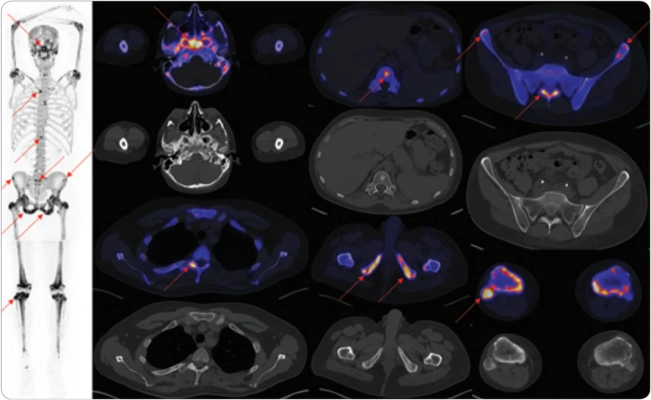  Vyšetření z počátku léčby pomocí NaF-PET/CT zobrazení.