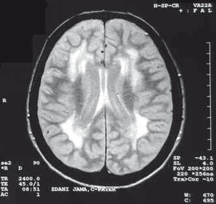 Hypersignální změny v bílé hmotě u pacientky s MD2, T2 vážený obraz.
Fig. 4. Hypersignal changes in the white matter in a patient with MD2, T2-weighted image.