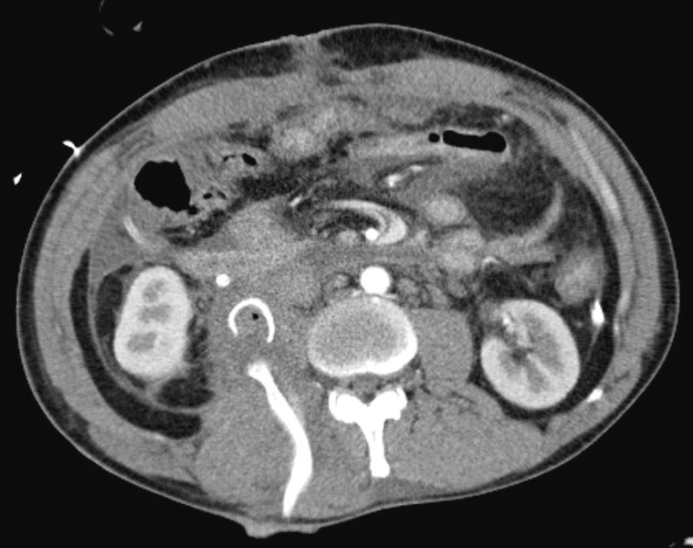 CT obraz po rekonstrukci: Stav po hemipankreatoduodenektomii, drenáž bodného kanálu
Fig. 2. CT view following reconstruction: Completed hemipancreatoduodenectomy, drainage of the stab canal