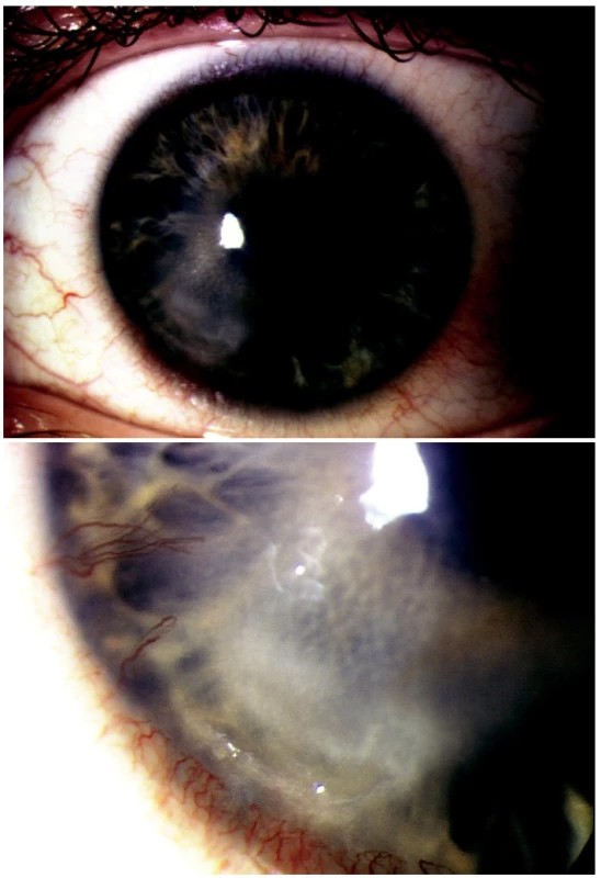 A. Keratouveitis herpetica recidivans PCR pozitivní
B. Detail epiteliálního defektu s hlubokou vaskularizací