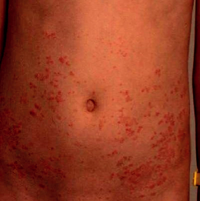 Gutátní výsev psoriázy.
Fig. 1. Eruption of psoriasis guttata.