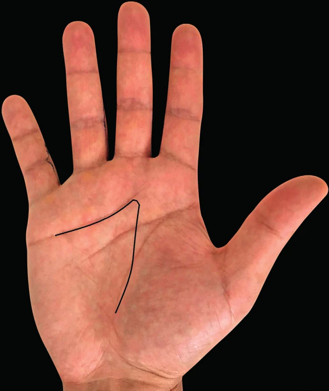 Incisions according to Burian