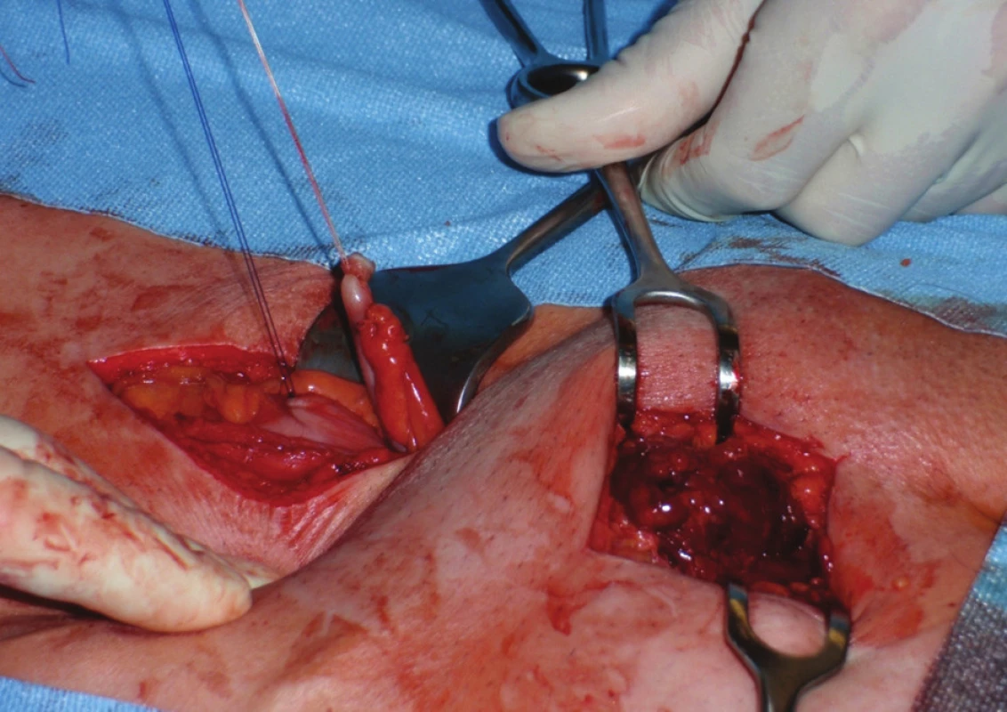 Peroperační nález – intaktní apendix v pararektálním řezu a gangrenózní tkáně v oblasti vaku femorální hernie
Fig. 2. Intraoperative findings – an intact appendix in pararectal incision and gangrenous tissue in femoral hernia