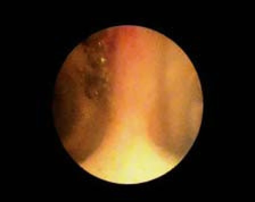 Zobrazení konfluens žlučovodů.
Fig. 4. Image of bile ducts confluence.