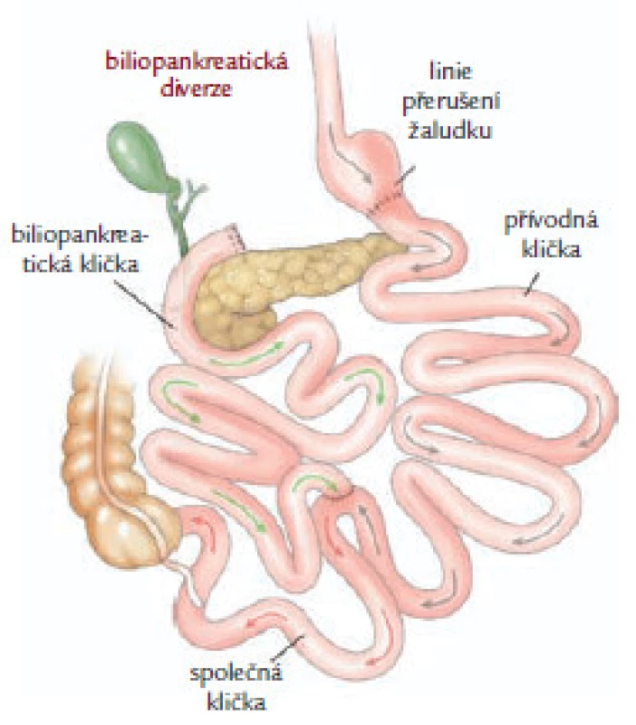 Malabsorpční výkon – biliopankreatická diverze (podle Scopinara).