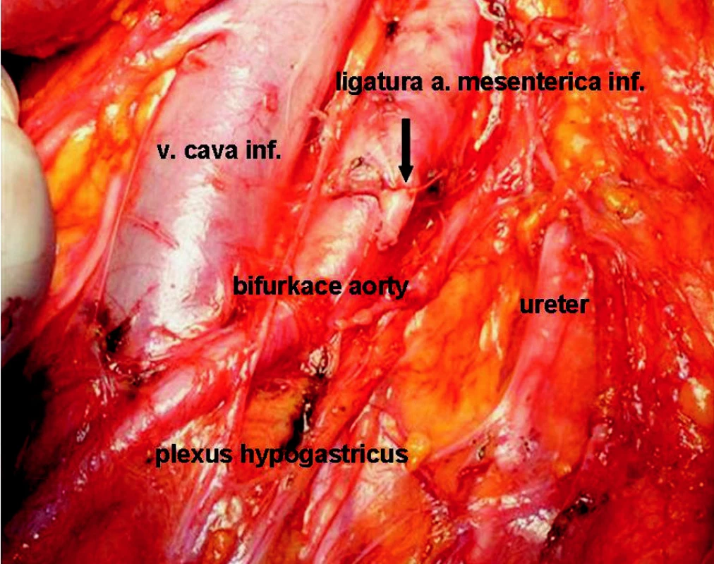 Stav po resekci sigmatu s radikální lymfadenektomií
Fig. 1. An operation field following sigmoid resection with radical lymphadenectomy