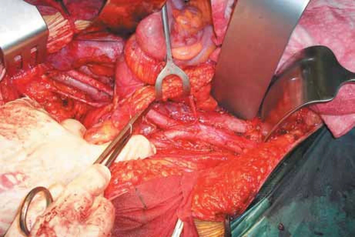 Pravé pánevní retroperitoneum, aorta a dolní dutá žíla.