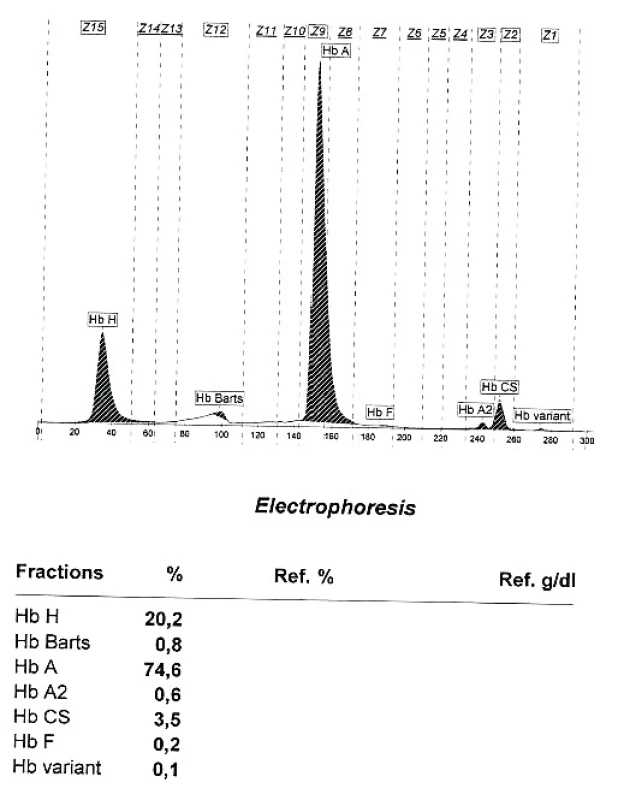 Kapilární ELFO hemoglobinu u nemocné s kombinací heterozygotní alfa talasemie a Hb Constant Spring