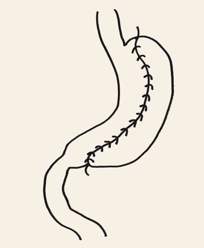 Plikace žludku.
Fig. 2. Gastric plication.