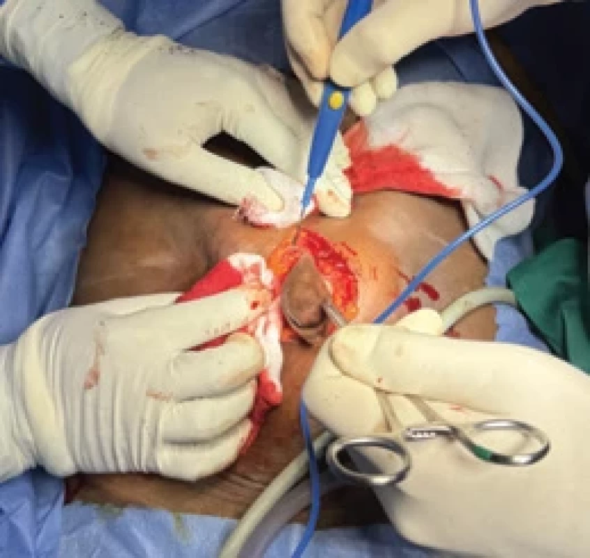 Excize umbilikálního nodulu. Fig. 2. Excision of the umbilical nodule.