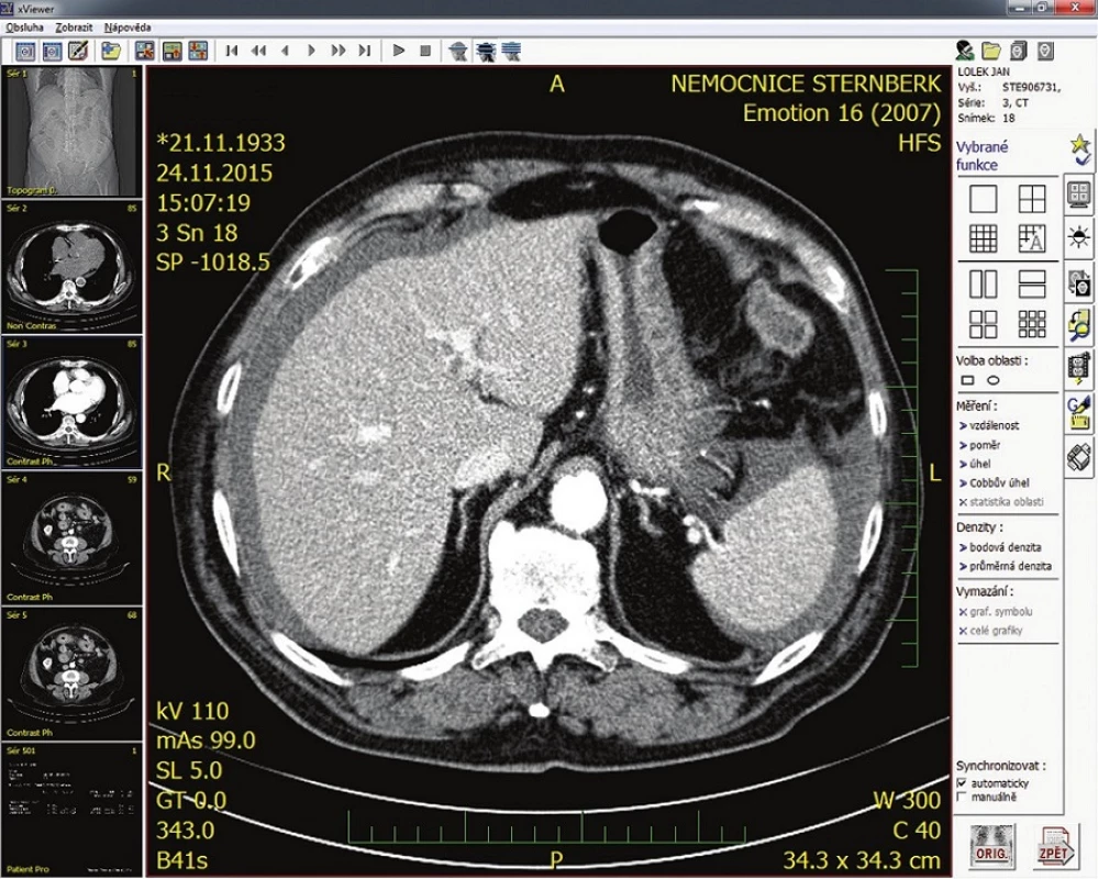 CT s infiltrovanou kličkou tenkého střeva
Fig. 1: CT with infiltrated small intestine