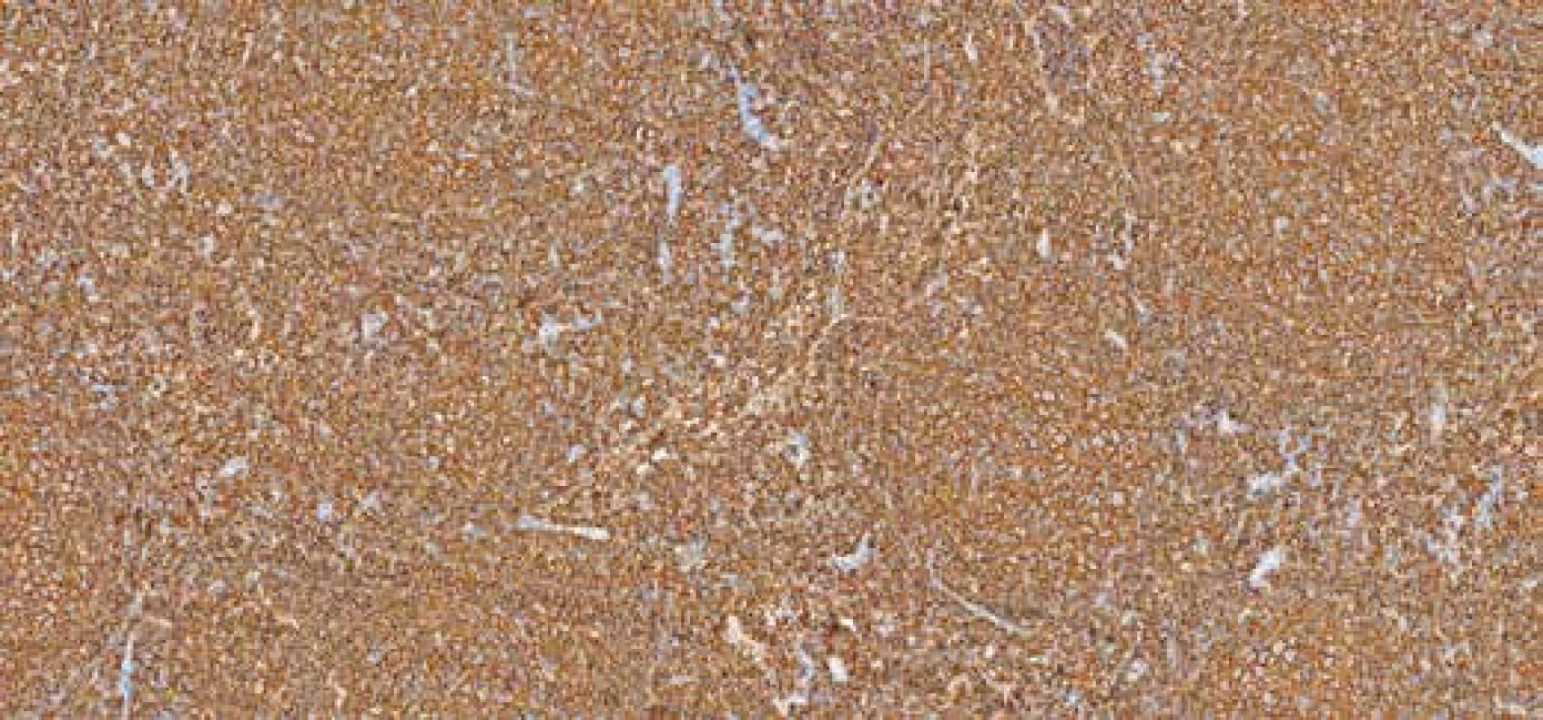 Imunohistochemický průkaz exprese CD20. Zvětšení 100x.