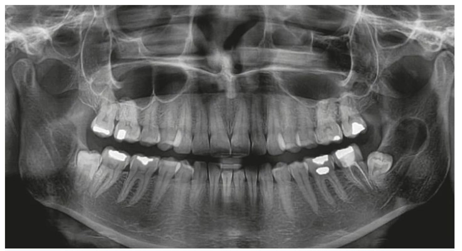 Ortopantomogram pacientky léčené s pracovní diagnózou folikulární cysty. Při histologickém vyšetření byla afekce klasifikována jako keratocystický odontogenní tumor