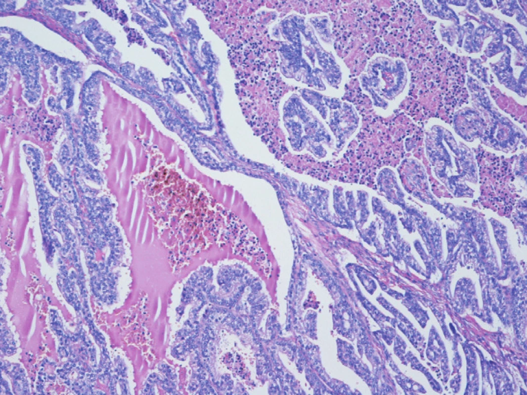 Metastáza karcinomu prostaty do nadvarlete – cystopapilární duktální struktura v základním barvení HE (zvětšeno 100x)
Fig. 1. Epididymal metastatis of prostate cancer – cystopapillary structure in hematoxyline-eosine (zoom 100x)