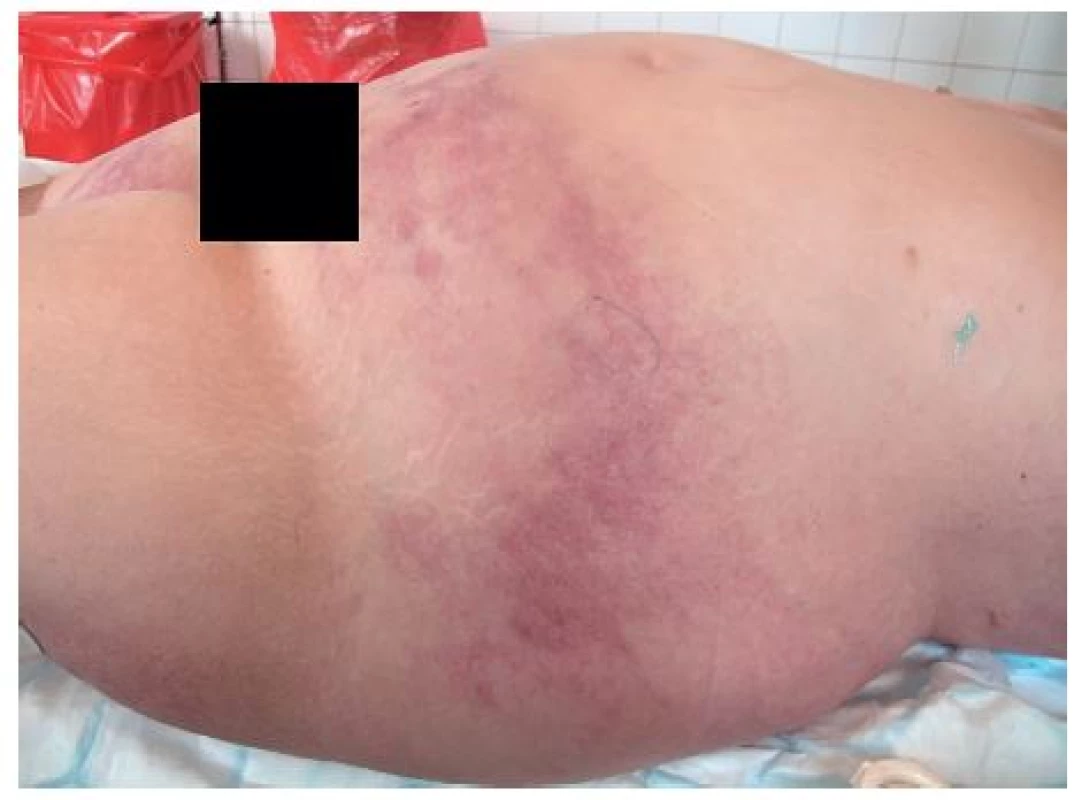 Vstupní klinický obraz hodnocený jako Erysipel