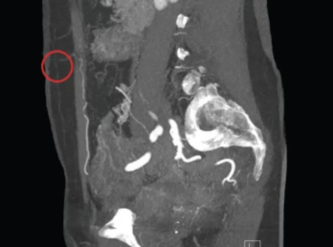 Coronal CT angiography image of the abdomen illustrating the connection between a perforating vessel and the superfi cial venous system.