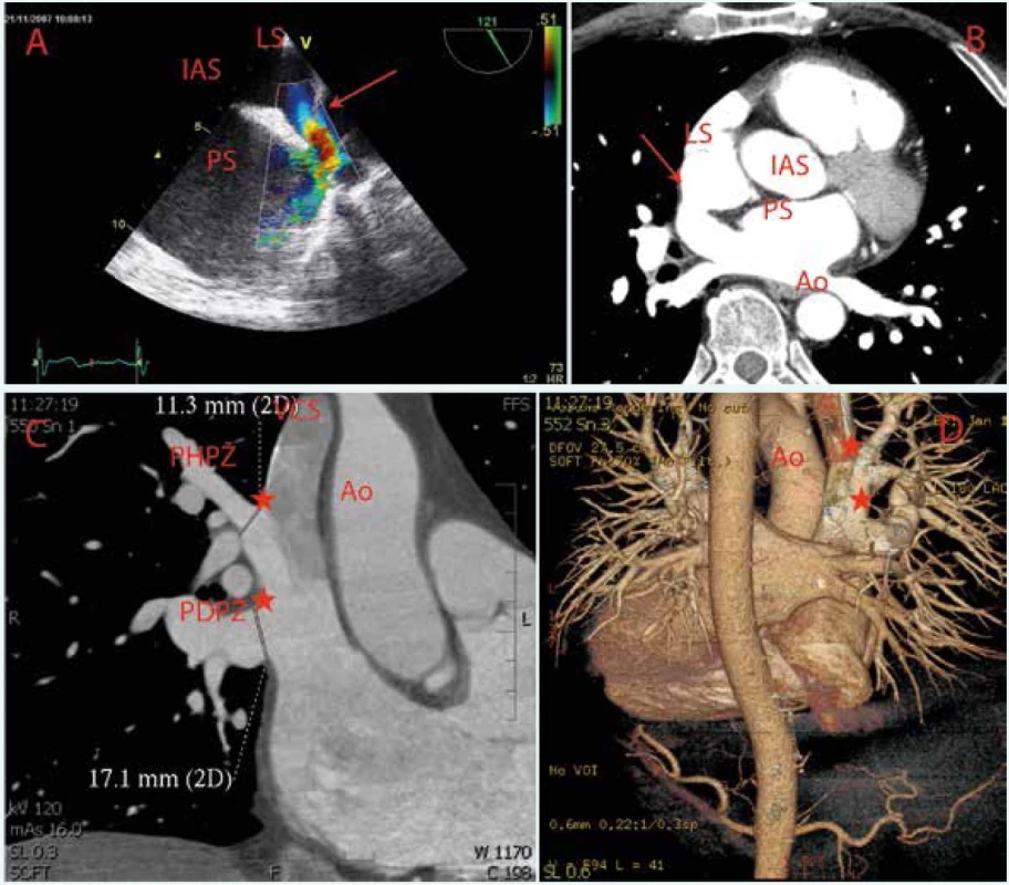 Defekt sinus versus superior s anomálním vústěním pravostranných plicních žil do horní duté žíly (hvězdy) v TEE zobrazení