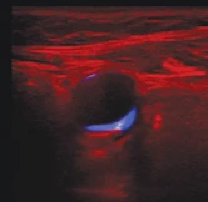 An example of three channel input for the regression network shown as an RGB image: the input image in red, its masked plaque region in green and the soft mask itself in blue. 