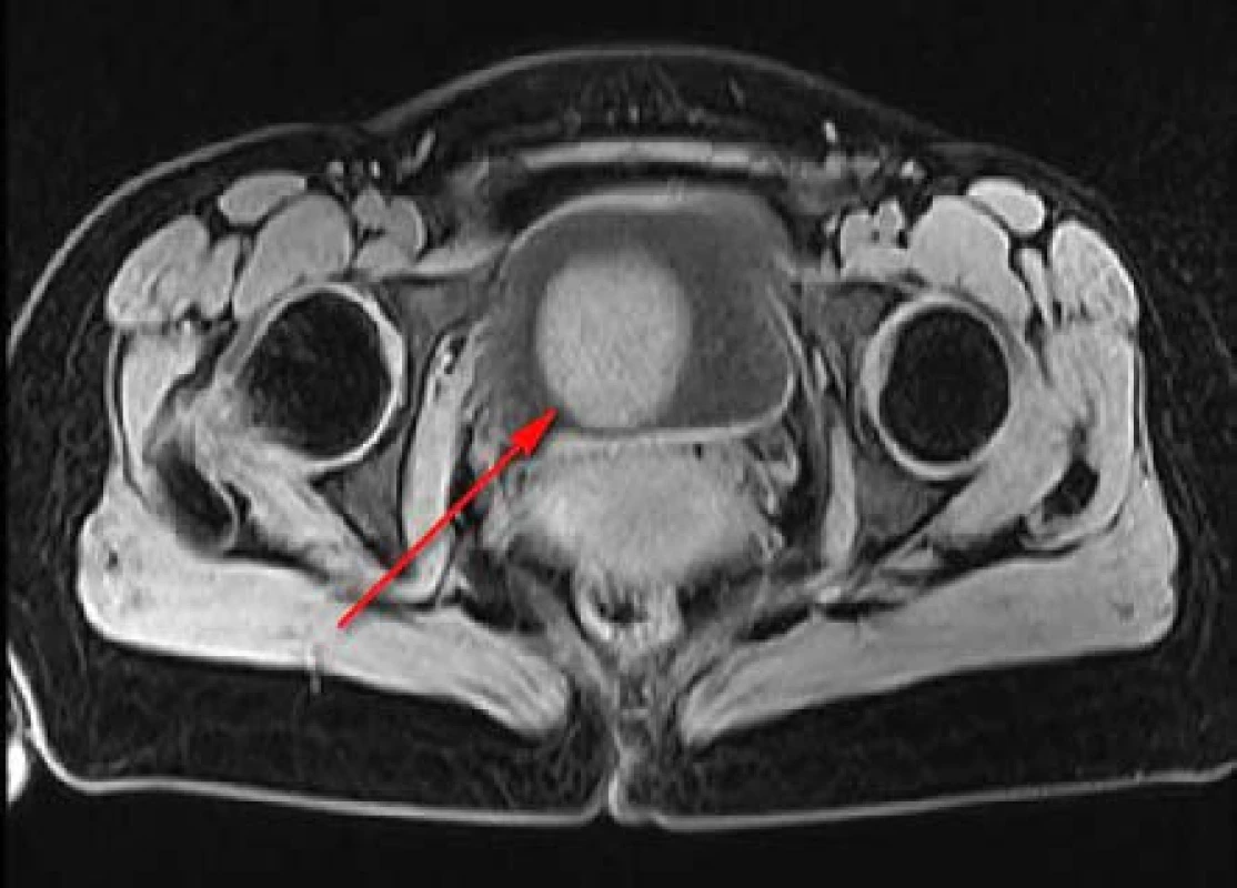 MR, axiální řez, T1 vážený obraz: homogenní, ohraničený, hladký, kulovitý útvar 
v močovém měchýři
Fig. 2. MR scan, axiall section, T1 weighted image: homogenous, smoothly marginated mass in the urinary bladder